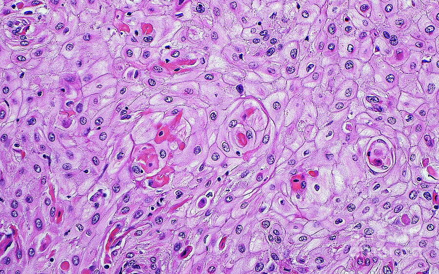Squamous Cell Carcinoma Of The Bladder by Ziad M. El-Zaatari / Science ...